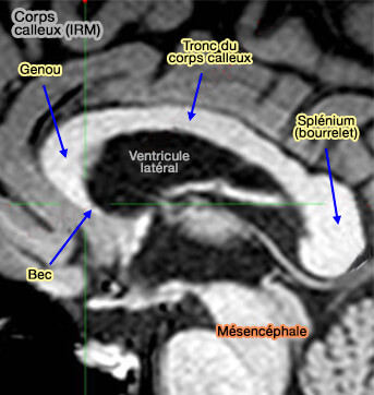 IRM du corps calleux
