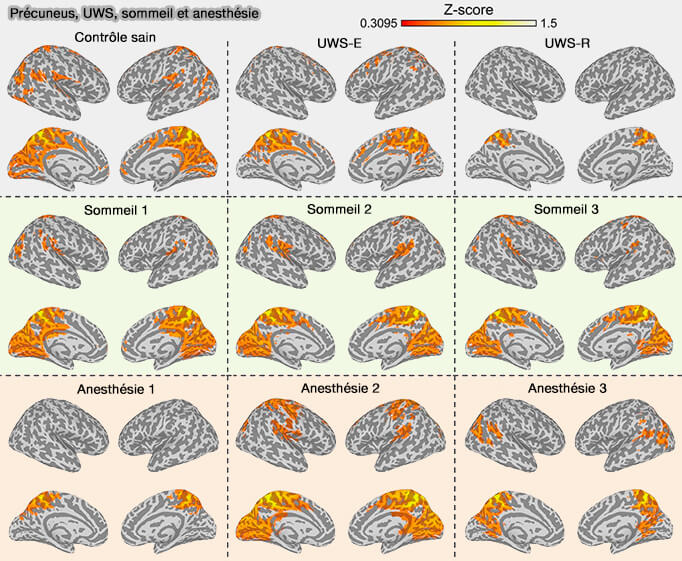 Précuneus, UWS, sommeil et anesthésie