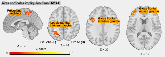Aires corticales impliquées dans UWS-E 