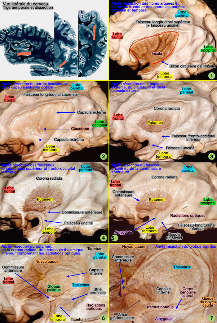 Tige temporale et dissection de la face latérale du cerveau