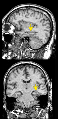 Hippocampe (IRM)